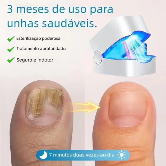 Tratamento de Onicomicose da Ponta do Dedo - Dispositivo a Laser e Luz Infravermelha para Fungos nas Unhas