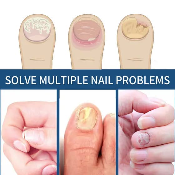 EELHOE adesivo para cuidados com as unhas, ingredientes suaves, superfície das unhas, suave, brilhante, respirável, adeq