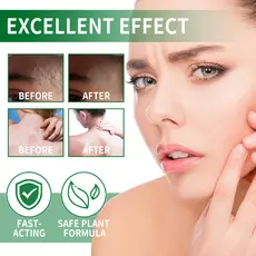 Creme Folículo Capilar South Moon , Limpador De Couro Cabeludo , Remoção De Acne , Reparo Nutritivo , Pomada Anticaspa