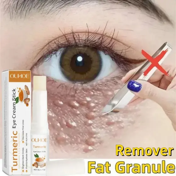 Grânulos De Gordura Dos Olhos Remoção Eyestick Anti-Inchaço Endurecimento Creme Inflamatório Desbotamento Linha Fina Rep
