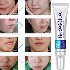 Creme para remoção de cicatrizes de acne/tratamento Anti-acne/clareamento/controle de óleo/cravos de poros