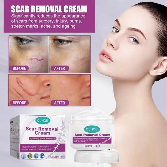 Creme Eliminar Cicatrizes Pretas Remover Feridas Antigas Picada de Mosquito Cicatriz Quelóide Queimaduras Scal -beleza