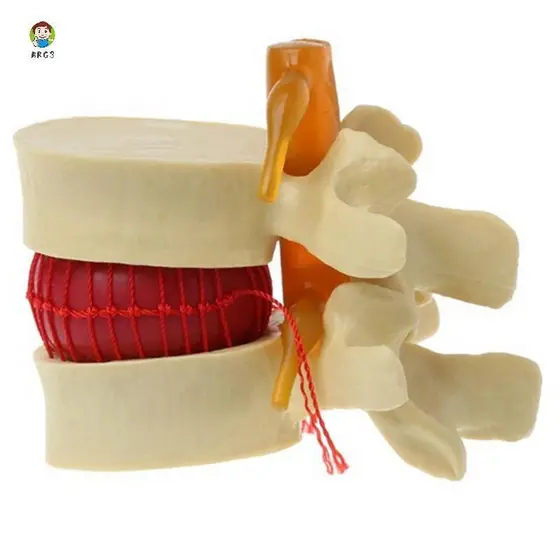 Modelo de Ensino de Anatomia da Coluna Lombar com Hérnia de Disco Intervertebral