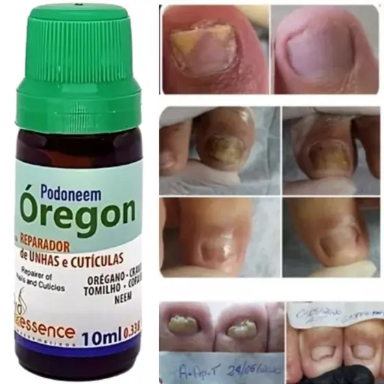 Reparador De Unhas E Cutículas Podoneem Óregon 10ml Pró Essence