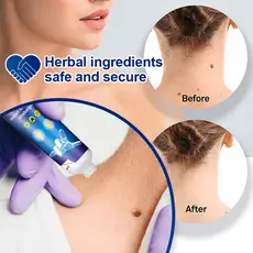 Creme Anti-Verrugas Para Sardas Suaviza Calos Hidratante Proteção Da Pele