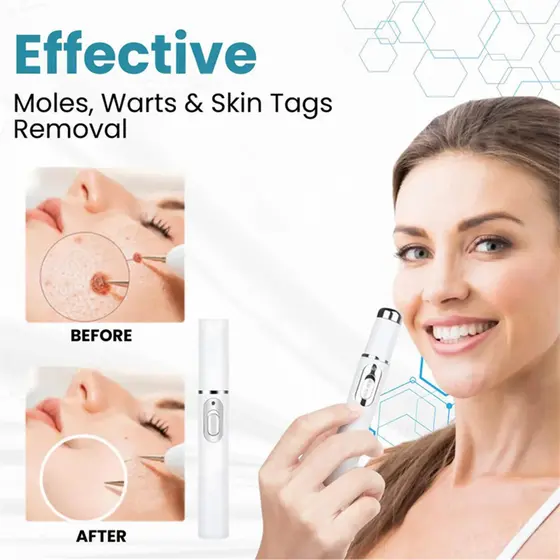 Caneta Laser Removedor De Mancha Acne E Limpeza