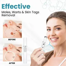 Caneta Laser Removedor De Mancha Acne E Limpeza