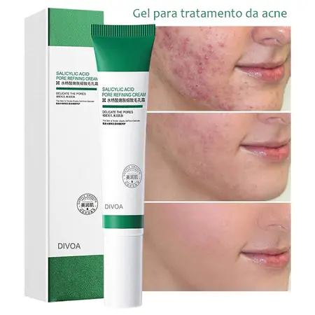 Creme Ácido Salicílico 20g - Reduz Poros, Controle Oleosidade, Pele Acneica, Remoção Acne Premium