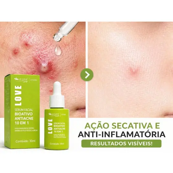 Sérum Facial Antiacne 10 em 1 da Max Love