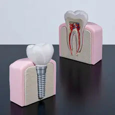 Modelo Anatômico Dente Molar ou Implante Estudo Anatômico Boca Dente. Decoração, presente, dentista