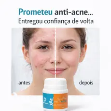 Creme ANTI ACNE 50g seca rápido fim das espinhas cravos e inflamações