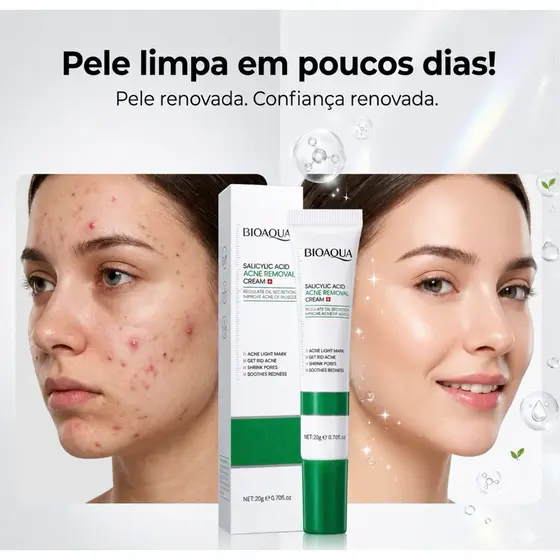 Creme De Acne Ácido Salicílico  Bioaqua Anti Acne Cravos Controle de Oleosidade Clareador Rápido 20g
