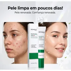 Creme De Acne Ácido Salicílico  Bioaqua Anti Acne Cravos Controle de Oleosidade Clareador Rápido 20g