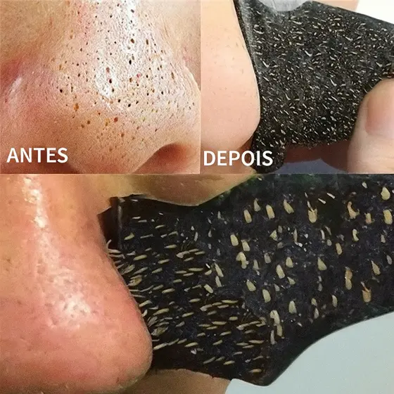 Kit 10 Adesivos Removedor de Cravos e Espinhas Para Nariz